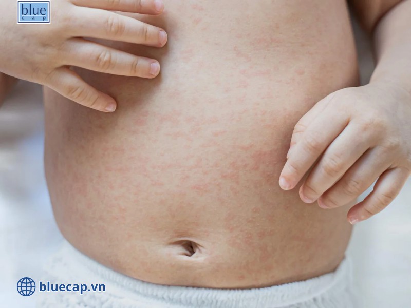 Trẻ bị chàm sữa khu vực vùng thân người