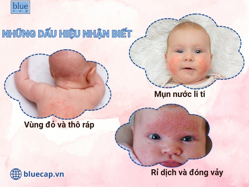 Các dấu hiệu nhận biết chàm sữa ở trẻ sơ sinh