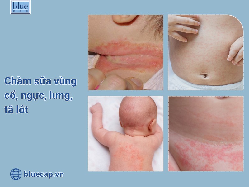 Hình ảnh chàm sữa ở trẻ sơ sinh vùng cổ và thân mình