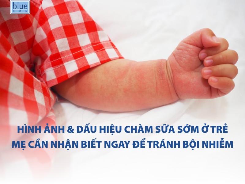 Hình ảnh & dấu hiệu chàm sữa sớm ở trẻ mẹ cần nhận biết ngay để tránh bội nhiễm
