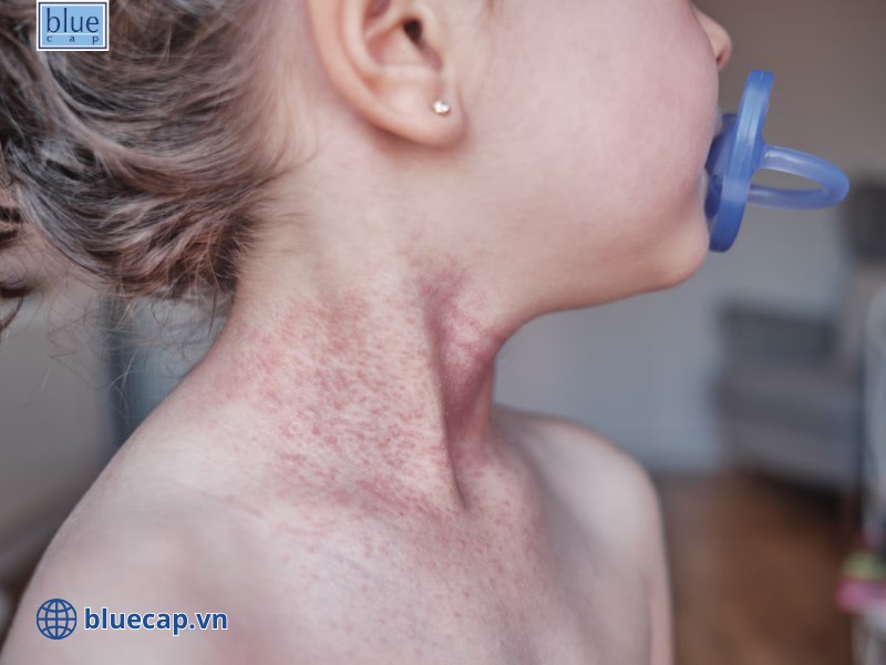 Trẻ bị chàm sữa ở cổ
