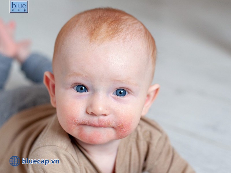Trẻ bị chàm sữa ở khu vực vùng mặt quanh miệng