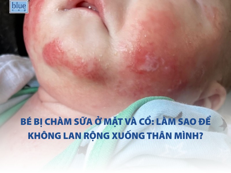 Bé bị chàm sữa ở mặt và cổ: Làm sao để không lan rộng xuống thân mình?