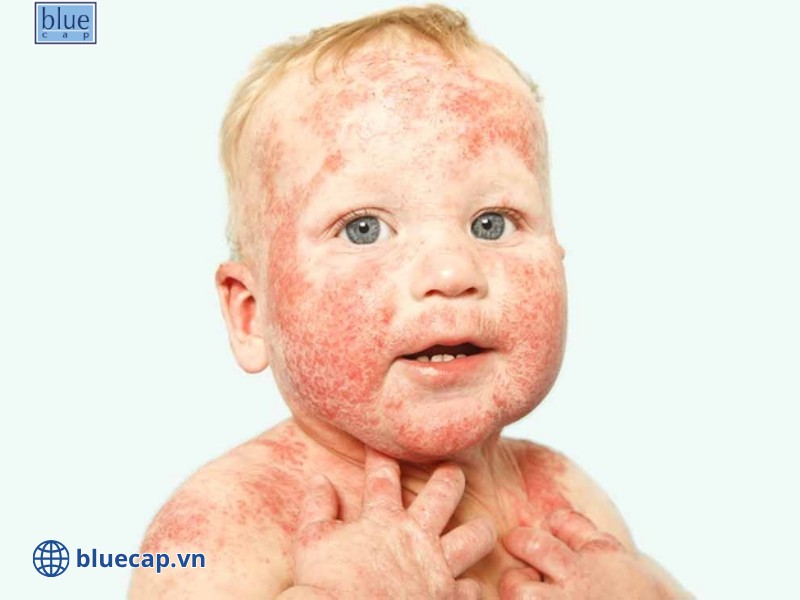 Chàm sữa có tự hết không phụ thuộc vào nhiều vào cách chăm sóc trẻ