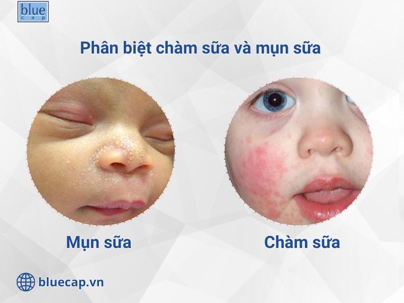 Phân biệt chàm sữa và mụn sữa tránh nhầm lẫn