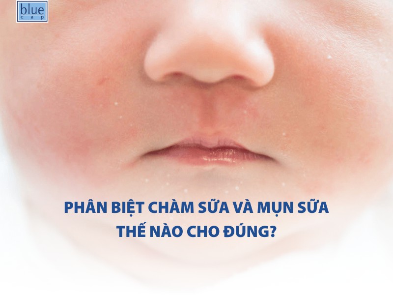 Phân biệt chàm sữa và mụn sữa thế nào cho đúng?