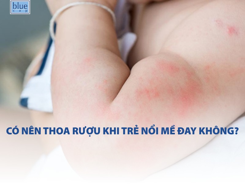 Có nên thoa rượu khi trẻ nổi mề đay không? Câu trả lời từ chuyên gia