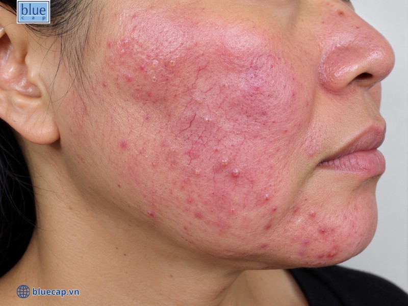 Minh họa trực quan trực quan ảnh hưởng nếu dùng corticoid sai cách