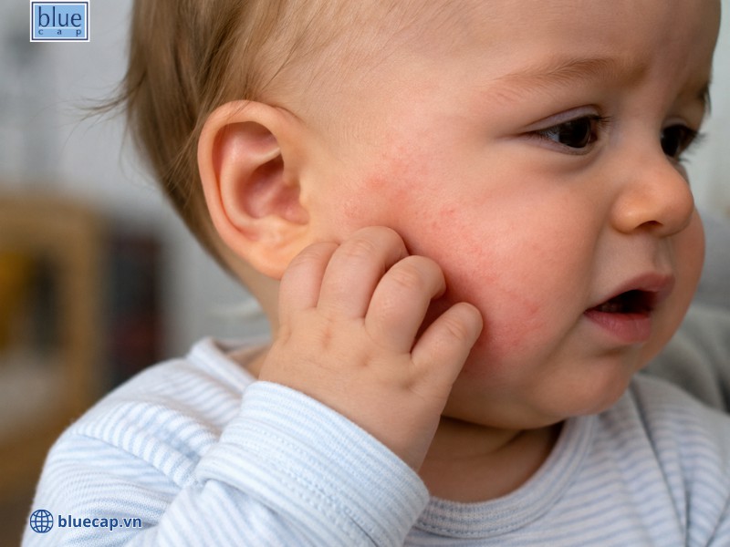 Hình ảnh trẻ bị chàm sữa ở khu vực má