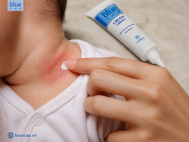 Luôn bôi kem cho vùng cổ bé bị chàm sữa hàng ngày