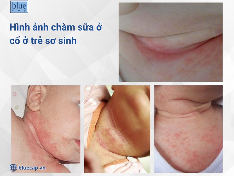 Hình ảnh chàm sữa ở cổ trẻ sơ sinh thực tế