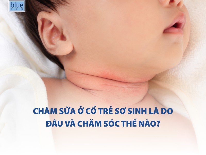 Chàm sữa ở cổ trẻ sơ sinh là do đâu và chăm sóc thế nào?