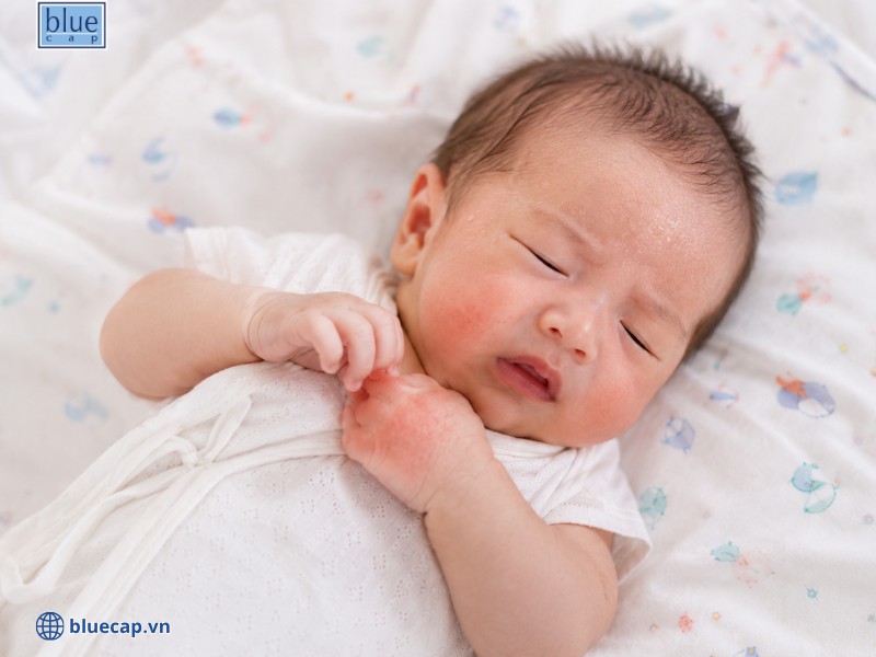 Bỏ qua mồ hôi, nước bọt, gãi ở trẻ nhỏ là sai lầm khi chăm sóc trẻ bị chàm sữa hay mắc của ba mẹ