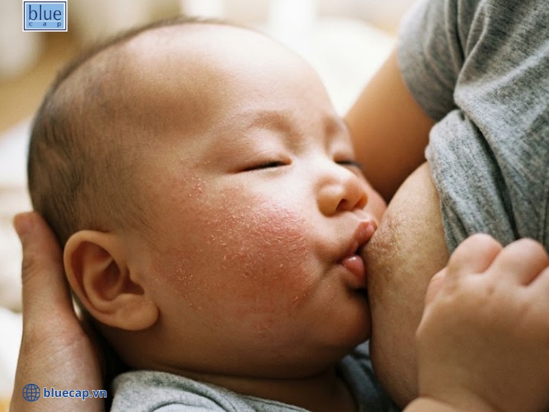 Không nên tự ý kiêng cữ khi chưa xác định thực phẩm gây kích ứng cho trẻ khi còn bú mẹ