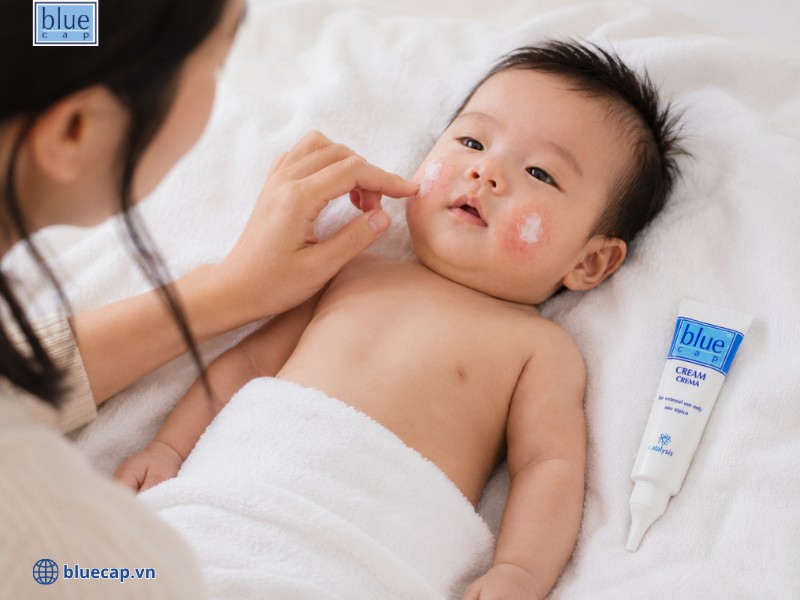 Ba mẹ có thể sử dụng kem bôi Blue Cap Cream khi con bị chàm sữa và dưỡng ẩm hàng ngày